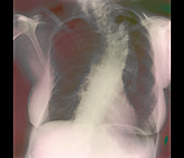 Scoliosis of spine