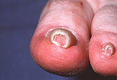 Involuted toenail