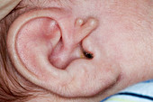 Ear deformity