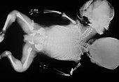 Two-headed infant,X-ray