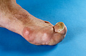 Enlarged big toe