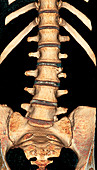 Spinal bone protrusion,3D CT scan