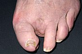 Amputation for ulcerated hammer toe