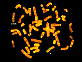 FISH micrograph of Williams syndrome chromosomes