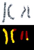 Translocation of chromosomes 5 and 14