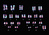 Philadelphia chromosome