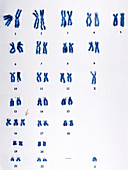 Trisomy 16 chromosomes