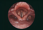 Paralysed vocal cord