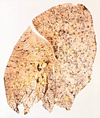 Section of human smoker's lung showing tar