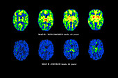 Smoking brain scans