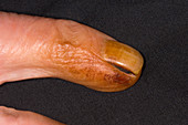 Smoker's finger