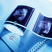 Foetus ultrasound