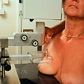 Needle biopsy of a woman's breast