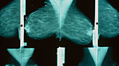 Series of breast mammograms on a lightbox