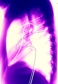 Colour X-ray depicting heart catheterization