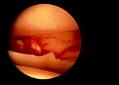 Endoscopic image of a damaged knee cartilage
