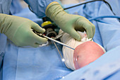 Knee biopsy surgery