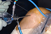 Knee biopsy surgery