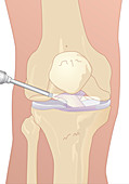 Knee arthroscopy,artwork