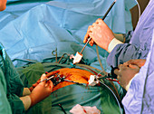 Endoscope in cholecystectomy (gallbladder removal)
