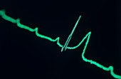 Third-degree heart block