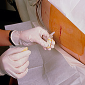 Lumbar puncture: taking a sample of spinal fluid