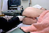 Ultrasound prostate biopsy