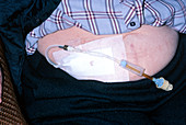 Home dialysis: elderly woman wearing a catheter