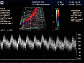 Kidney dialysis,Doppler ultrasound