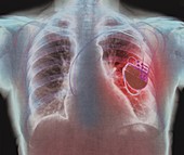 Heart pacemaker,X-ray