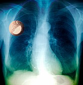 Heart pacemaker,X-ray