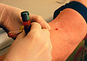 Drawing blood for a liver function test