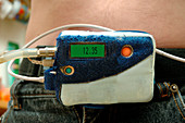 Ambulatory blood pressure monitor