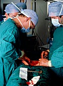 Surgery to perform a radical hysterectomy