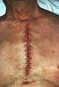 Stitched chest wound