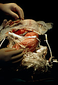 Open uterus fetal surgery: repair complete