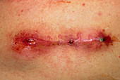 Wound sinus - post-operative infection