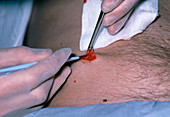 Close-up of the excision of a mole