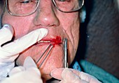 Stitching of elderly man's lacerated lip