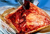 Surgery on ruptured quadriceps muscle of leg