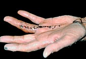 Sutured hand: corrected Dupuytren's contracture