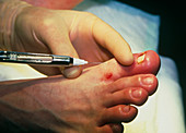 Toenail surgery