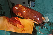 Surgically-removed enlarged spleen