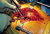 Hip replacement surgery