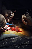 Bowel surgery