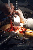 Bowel surgery