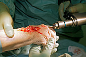 Carpal tunnel syndrome surgery