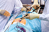 Hernia operation