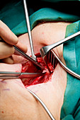 Varicose vein surgery