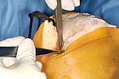 Knee replacement surgery